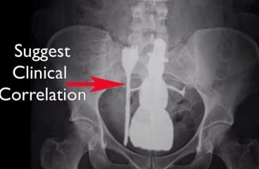 rectal snowman | zdoggmd.com